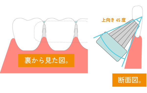 歯間をきれいに磨くことが大切